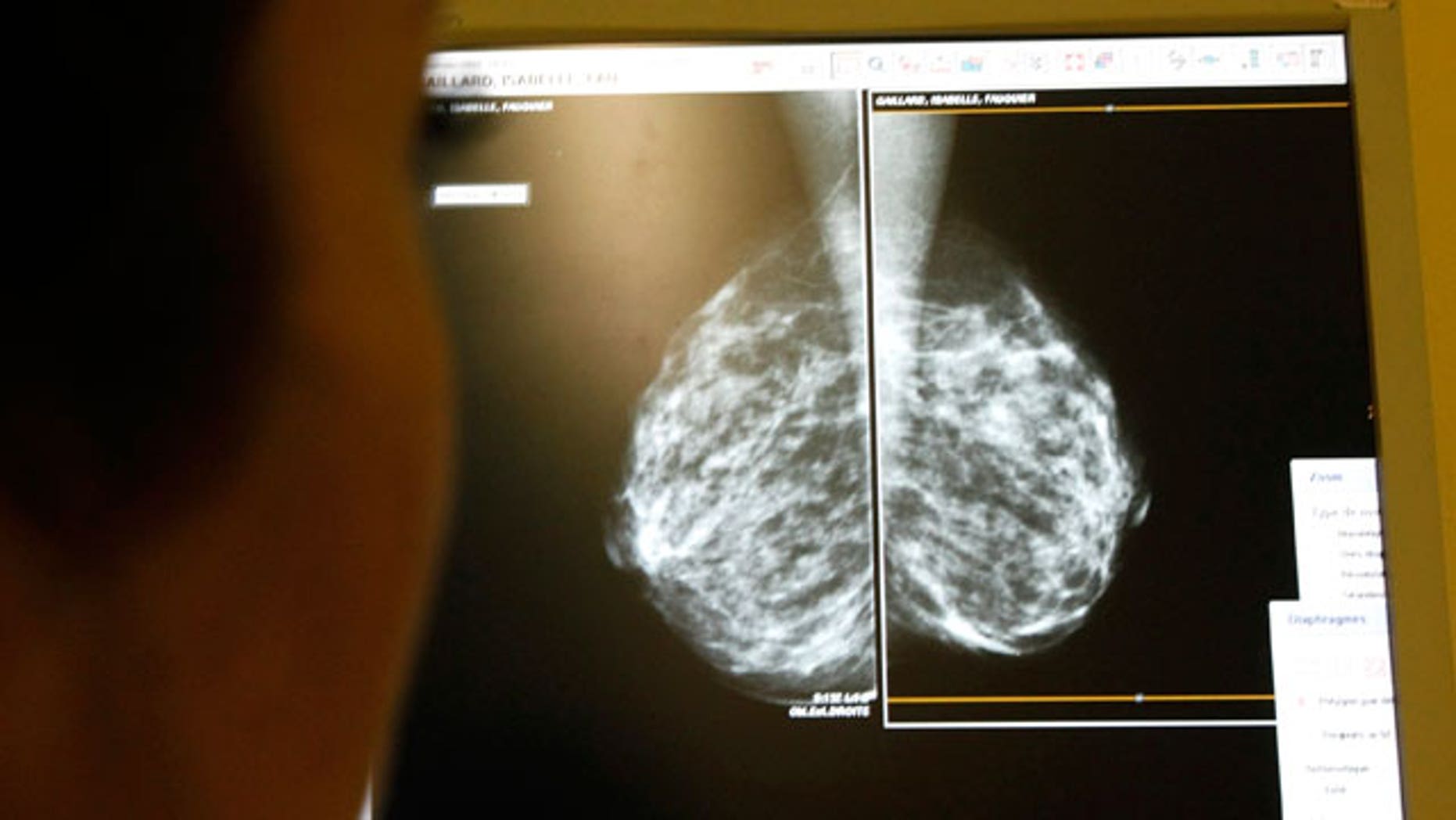 2019 year - Most Breast Cancer Patients Have Help Choosing Treatments 2019 year